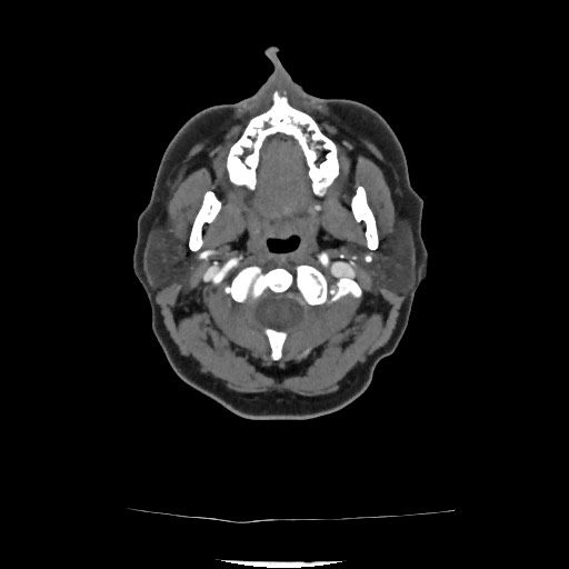 Acute subarachnoid hemorrhage and accessory anterior cerebral artery (Radiopaedia 69231-79009 Axial C+ arterial phase 67).jpg