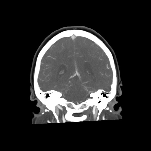 Acute subarachnoid hemorrhage and accessory anterior cerebral artery (Radiopaedia 69231-79009 Coronal C+ arterial phase 53).jpg