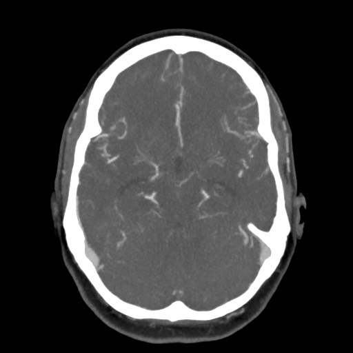 Acute subarachnoid hemorrhage and accessory anterior cerebral artery (Radiopaedia 69231-79009 D 28).jpg