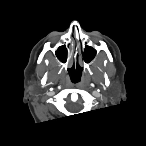 Acute subarachnoid hemorrhage and accessory anterior cerebral artery (Radiopaedia 69231-79009 D 4).jpg