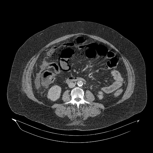 Acute superior mesenteric artery occlusion (Radiopaedia 51288-56960 Axial C+ portal venous phase 54).jpg