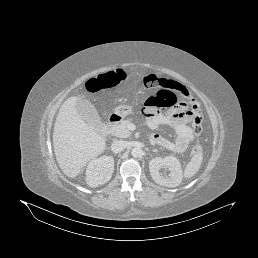 Acute superior mesenteric artery occlusion (Radiopaedia 51288-56960 Axial lung window 15).jpg