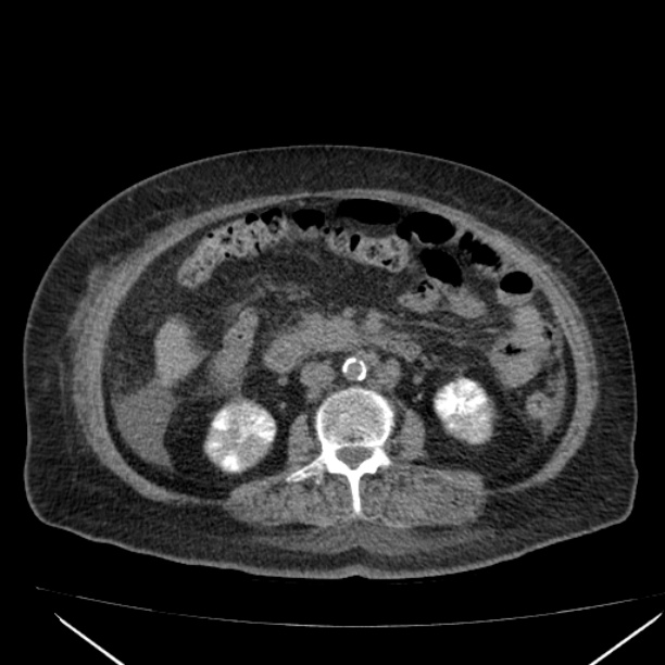 Acute tubular necrosis (Radiopaedia 28077-28334 Axial non-contrast 35).jpg