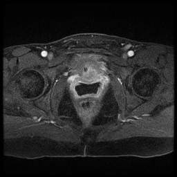 File:Adenocarcinoma arising in a urethral diverticulum (Radiopaedia 12400-12657 Axial T1 C+ fat sat 4).jpg