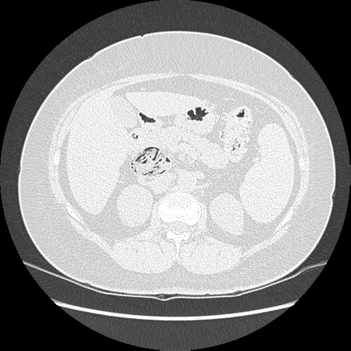 Adenocarcinoma in situ of lung (Radiopaedia 38685-40829 B 242).png