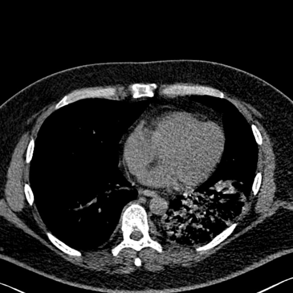 Adenoid cystic carcinoma of the trachea (Radiopaedia 49042-54137 Axial non-contrast 228).jpg