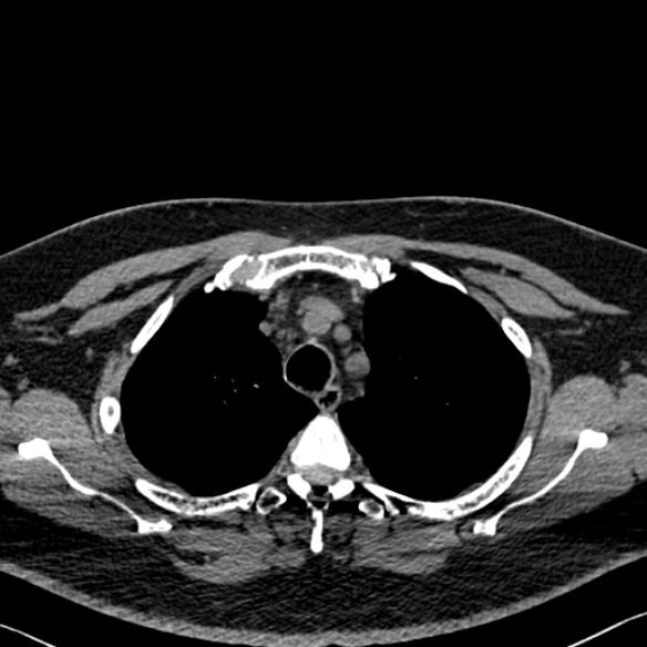 File:Adenoid cystic carcinoma of the trachea (Radiopaedia 49042-54137 Axial non-contrast 77).jpg