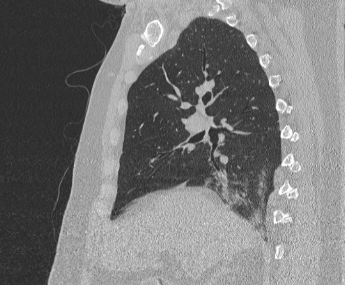 Adenoid cystic carcinoma of the trachea (Radiopaedia 49042-54137 Sagittal lung window 184).jpg