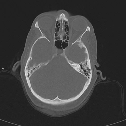 File:Adenoid cystic tumor of palate (Radiopaedia 46980-51518 Axial bone window 12).png