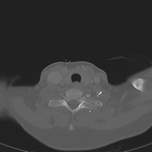 File:Adenoid cystic tumor of palate (Radiopaedia 46980-51518 Axial bone window 59).png