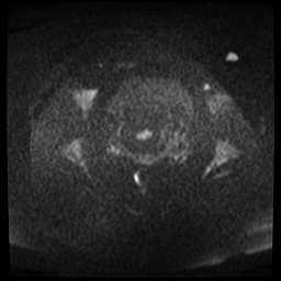 File:Adenomyosis-scar endometriosis (Radiopaedia 65863-75022 Axial DWI 13).jpg