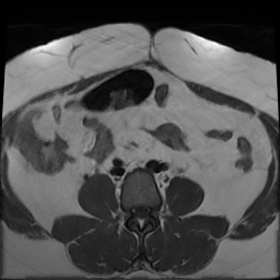 File:Adenomyosis within a didelphys uterus (Radiopaedia 70175-80215 Axial T1 8).jpg