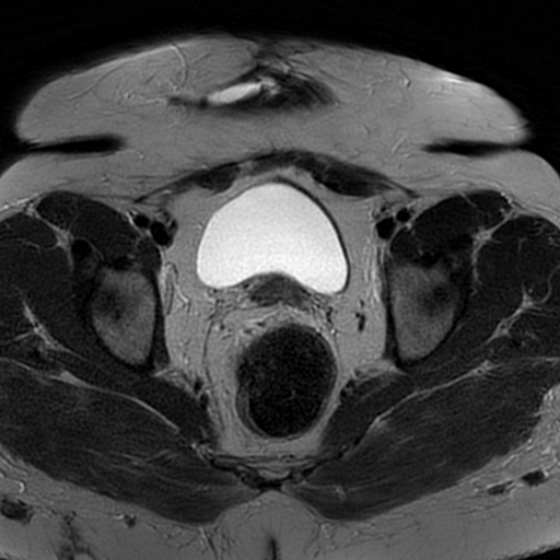 File:Adenomyosis within a didelphys uterus (Radiopaedia 70175-80215 Axial T2 23).jpg