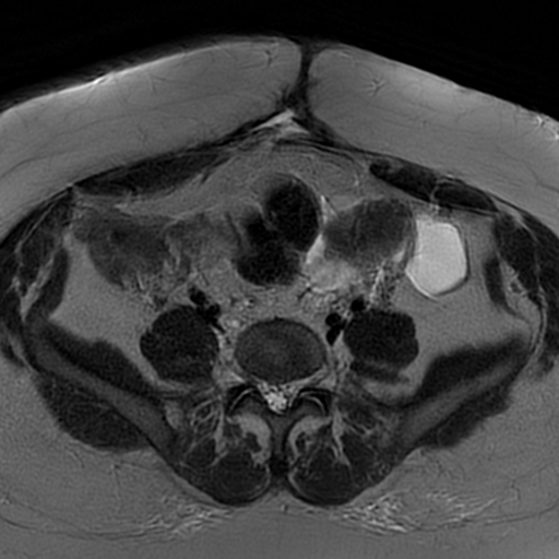 File:Adenomyosis within a didelphys uterus (Radiopaedia 70175-80215 Axial T2 6).jpg