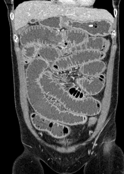 Adhesional small bowel obstruction (Radiopaedia 48397-53305 Coronal C+ portal venous phase 101).jpg
