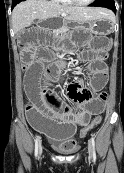 File:Adhesional small bowel obstruction (Radiopaedia 48397-53305 Coronal C+ portal venous phase 121).jpg
