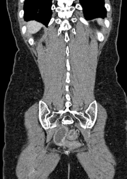 Adhesional small bowel obstruction (Radiopaedia 48397-53305 Coronal C+ portal venous phase 299).jpg