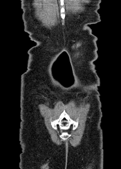 Adhesional small bowel obstruction (Radiopaedia 48397-53305 Coronal C+ portal venous phase 335).jpg