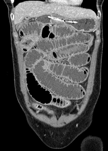 Adhesional small bowel obstruction (Radiopaedia 48397-53305 Coronal C+ portal venous phase 90).jpg