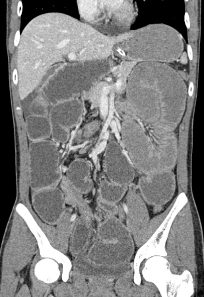 Adhesional small bowel obstruction (Radiopaedia 52107-57980 Coronal C+ portal venous phase 37).jpg