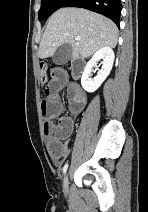 Adhesional small bowel obstruction (Radiopaedia 58900-66131 Sagittal C+ portal venous phase 77).jpg