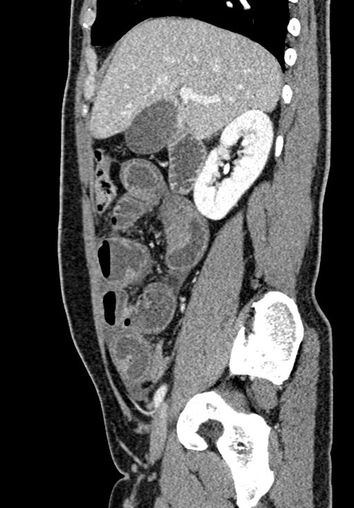 Adhesional small bowel obstruction (Radiopaedia 58900-66131 Sagittal C+ portal venous phase 80).jpg