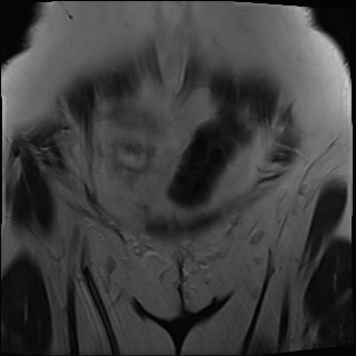 File:Adnexal multilocular cyst (O-RADS US 3- O-RADS MRI 3) (Radiopaedia 87426-103754 Coronal T2 4).jpg