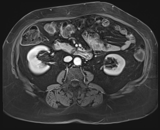 Adrenal cortical carcinoma (Radiopaedia 64017-72770 J 51).jpg