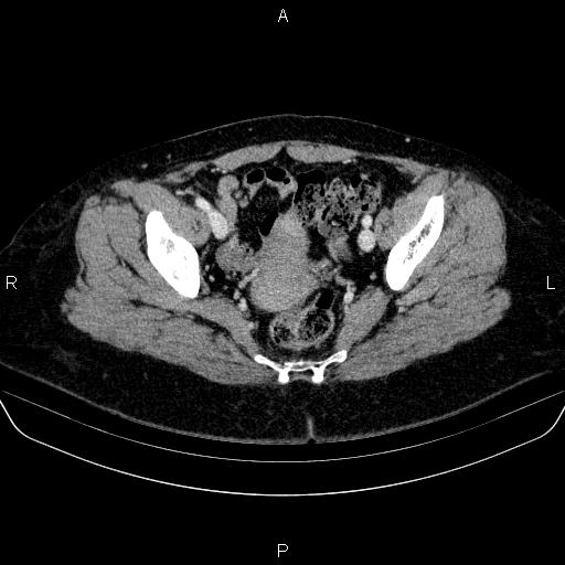 File:Adrenal cortical carcinoma (Radiopaedia 84882-100379 Axial C+ portal venous phase 84).jpg