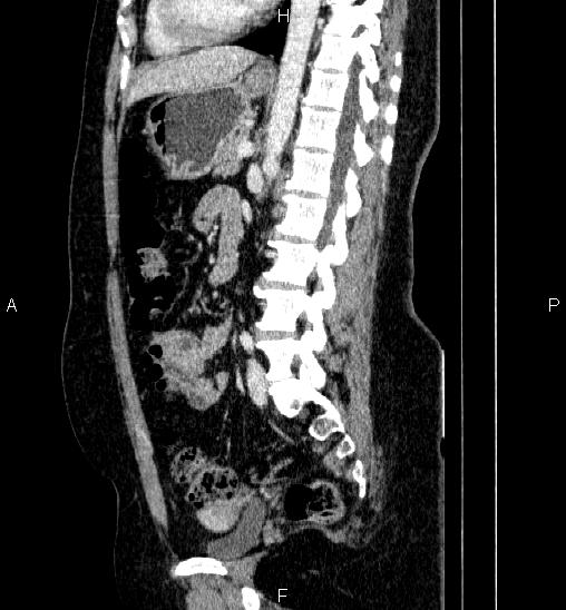 Adrenal cortical carcinoma (Radiopaedia 84882-100379 Sagittal C+ portal venous phase 52).jpg