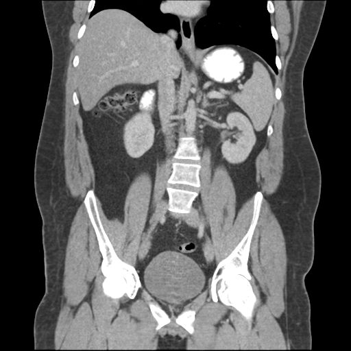 File:Adrenal cyst (Radiopaedia 45625-49776 Coronal C+ portal venous phase 42).png