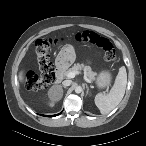 File:Adrenal cyst (Radiopaedia 45625-49777 Axial C+ portal venous phase 35).png