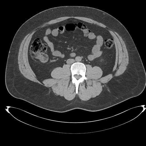 Adrenal cyst (Radiopaedia 45625-49778 Axial non-contrast 74).png