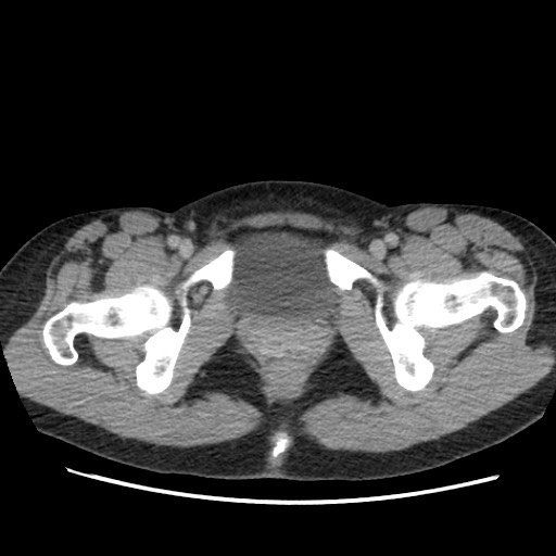 Adrenal cyst (Radiopaedia 64869-73813 Axial C+ portal venous phase 79).jpg