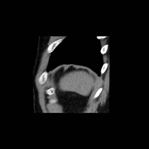 Adrenal gland trauma (Radiopaedia 81351-95079 Sagittal non-contrast 94).jpg
