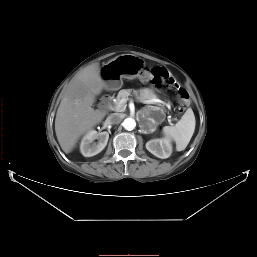 Adrenal hemangioma (Radiopaedia 68923-78668 Axial C+ arterial phase 31).jpg