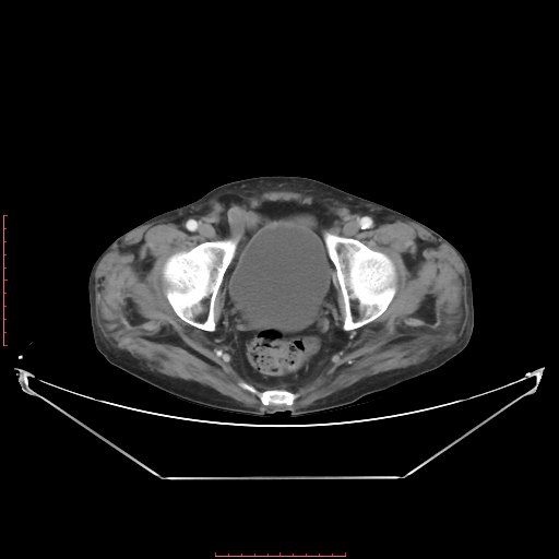 Adrenal hemangioma (Radiopaedia 68923-78668 Axial C+ portal venous phase 65).jpg