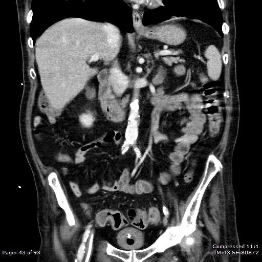 Adrenal metastasis (Radiopaedia 78425-91079 Sagittal C+ portal venous phase 30).jpg