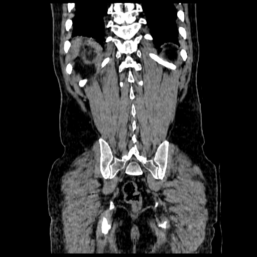 File:Adrenal myelolipoma (Radiopaedia 41843-44834 Coronal non-contrast 22).jpg