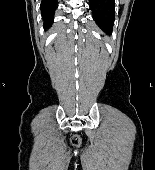 Adrenal myelolipoma (Radiopaedia 87794-104246 Coronal renal cortical phase 60).jpg