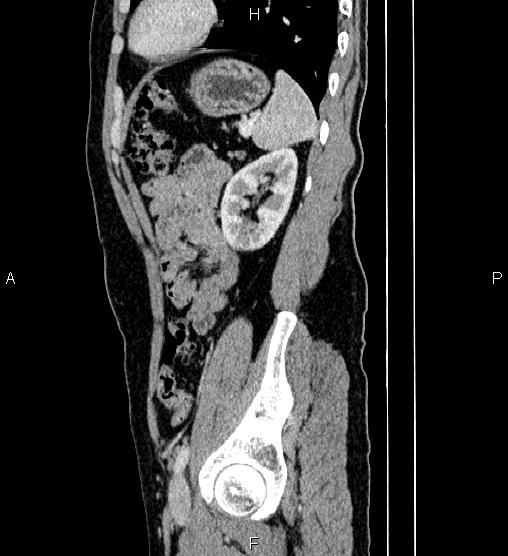 Adrenal myelolipoma (Radiopaedia 87794-104246 Sagittal renal cortical phase 72).jpg