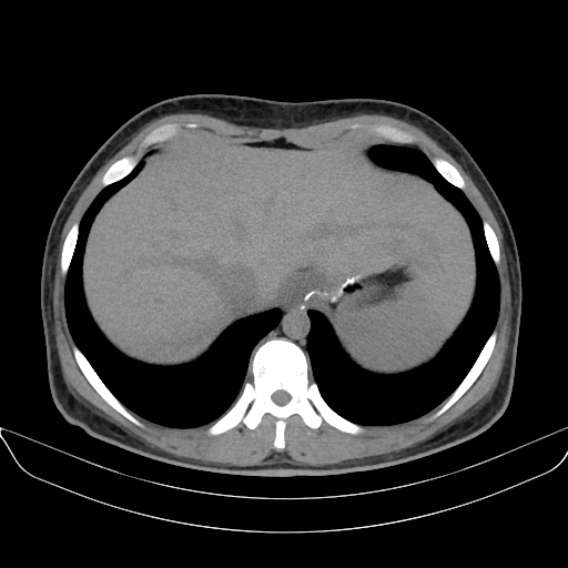 Adrenal myelolipoma - bilateral (Radiopaedia 74805-85810 Axial non-contrast 10).jpg