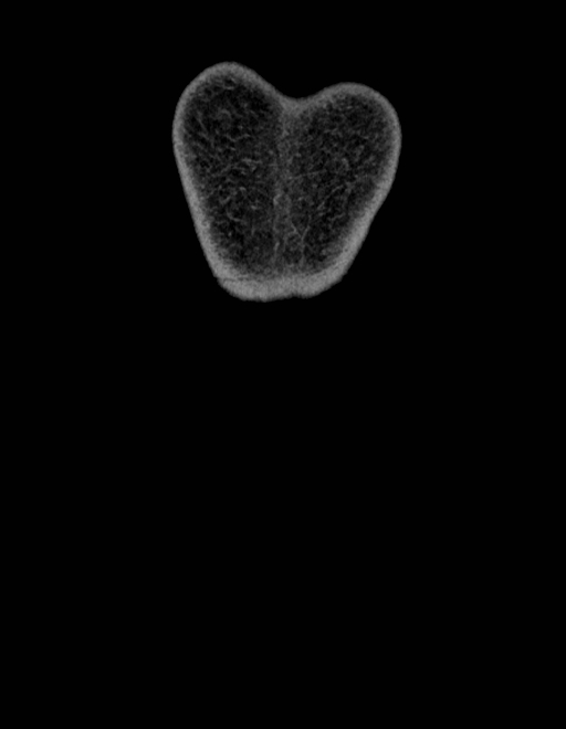 Adrenal myelolipoma - bilateral (Radiopaedia 74805-85810 Coronal C+ portal venous phase 274).jpg