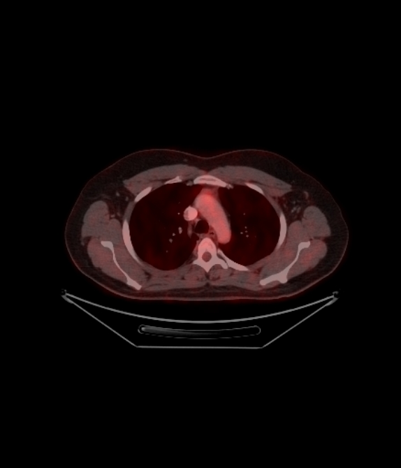 Adrenocortical carcinoma (Radiopaedia 80134-93440 ِAxial 102).jpg