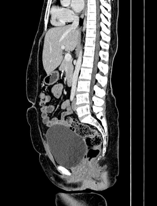 Adrenocortical carcinoma (Radiopaedia 87281-103569 Sagittal C+ portal venous phase 149).jpg