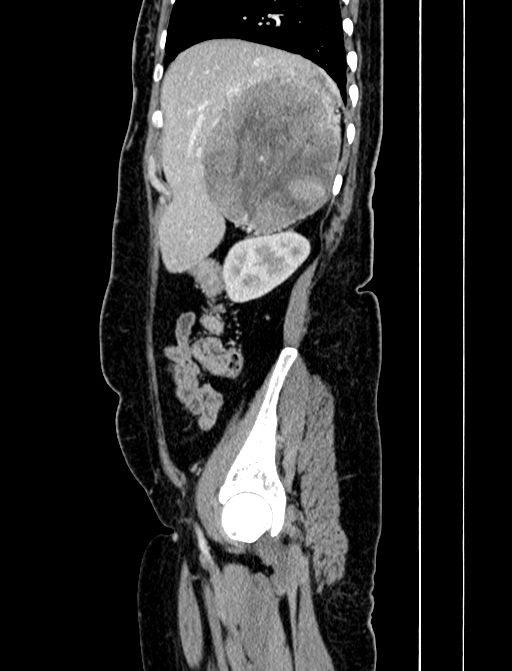 Adrenocortical carcinoma (Radiopaedia 87281-103569 Sagittal C+ portal venous phase 60).jpg