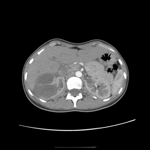 Adult polycystic kidney disease (Radiopaedia 48845-53876 Axial renal cortical phase 15).jpg