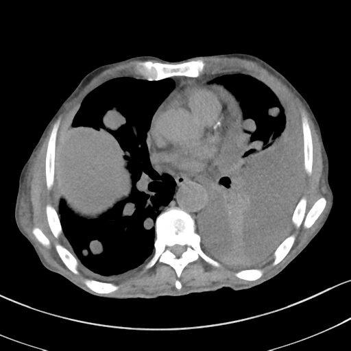 Advanced metastatic lung cancer (Radiopaedia 48910-53954 Axial non-contrast 36).png