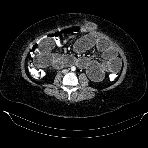 Afferent loop syndrome - secondary to incarcerated trocar site hernia (Radiopaedia 82959-97305 Axial C+ portal venous phase 132).jpg