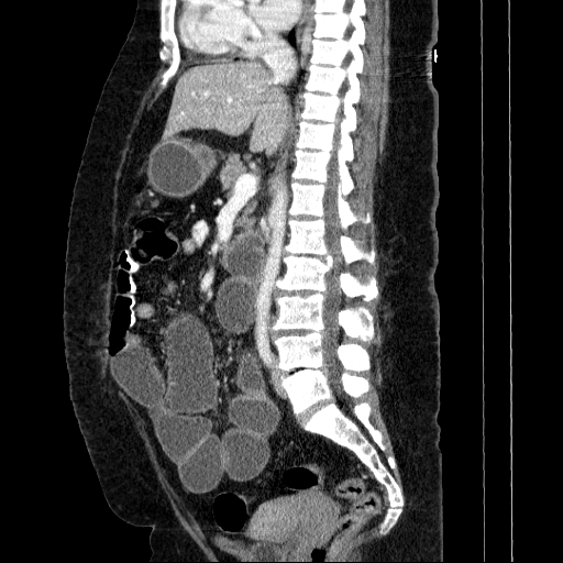 Afferent loop syndrome - secondary to incarcerated trocar site hernia (Radiopaedia 82959-97305 Sagittal C+ portal venous phase 79).jpg